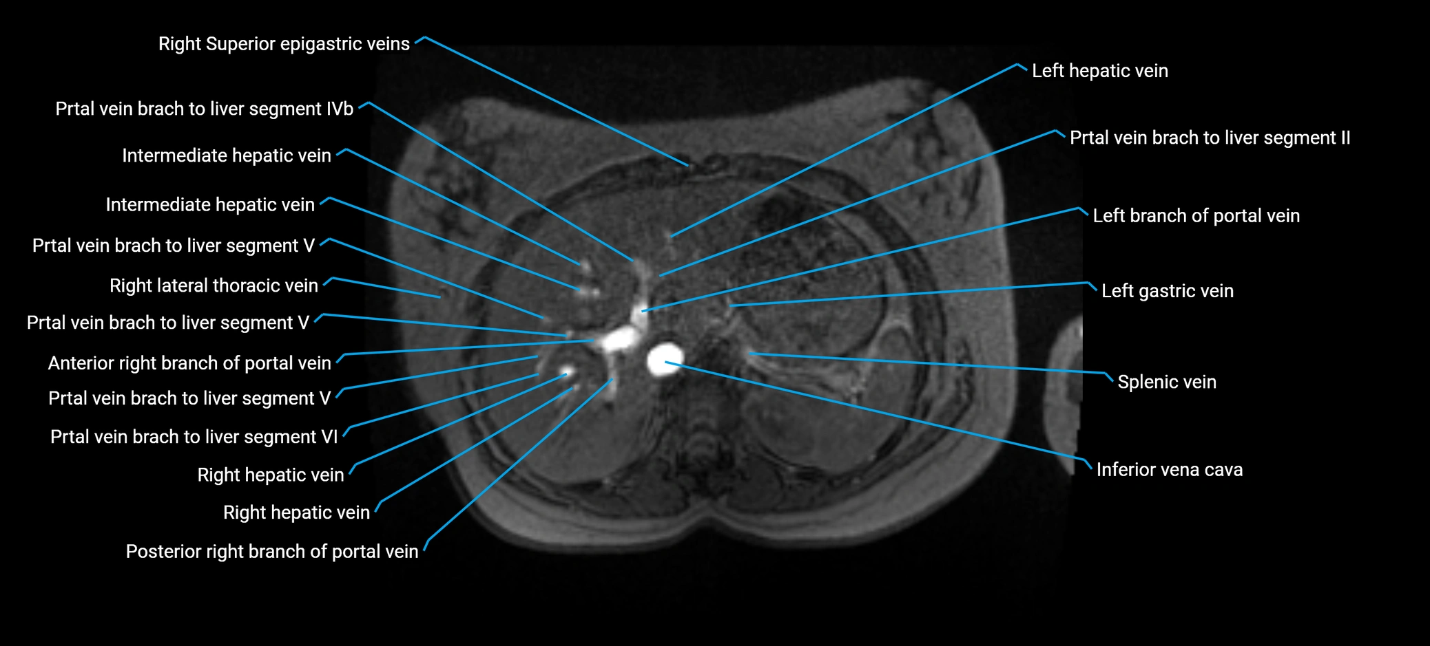 MRV abdomen pelvis & lower limb axial cross sectional anatomy labelled MRI image 39 (1).webp